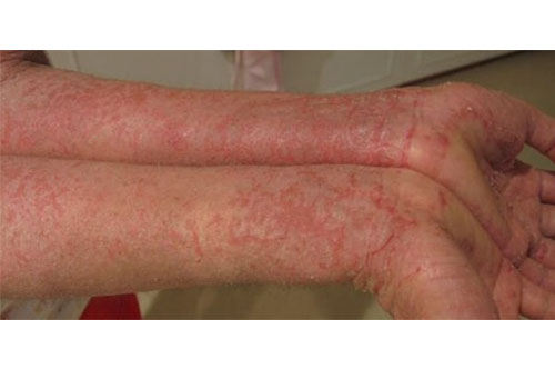 Atopik Dermatit Nedir?