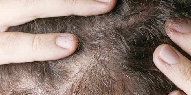Saç Hastalıkları Nedir?